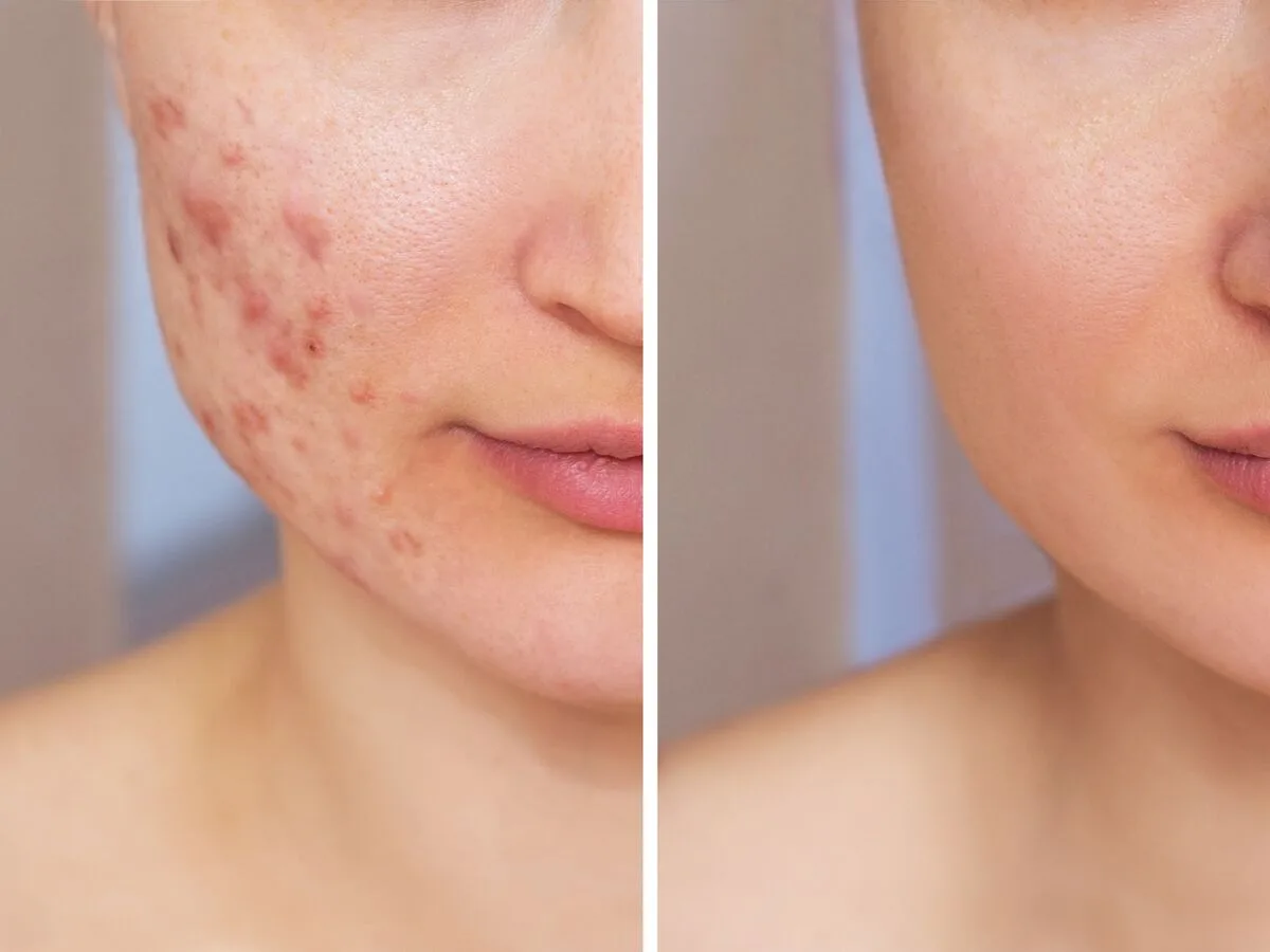 Acne & Breakout-Prone Skin